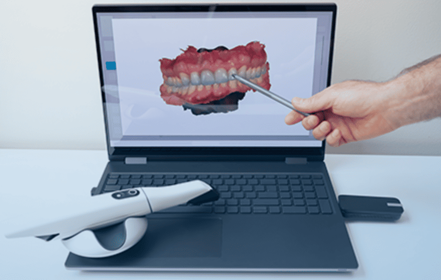 Intraoral Scanners: Transforming Clear Aligner Production